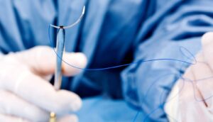 do barbed sutures dissolve