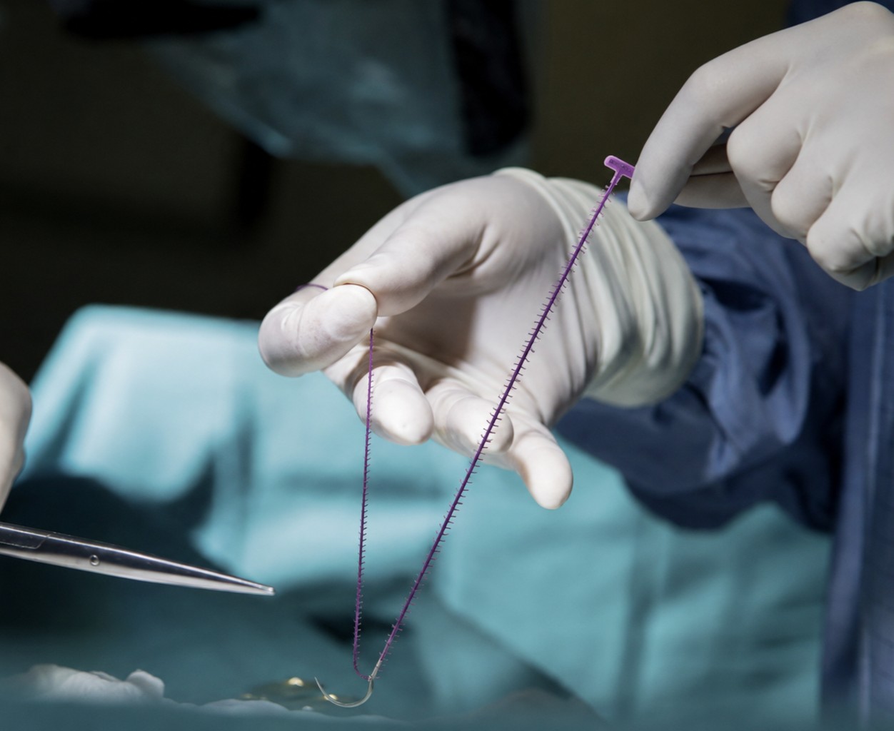 barbed surgical sutures